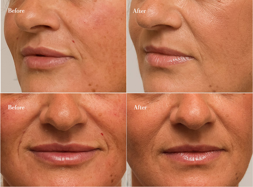 dermal fillers before and after