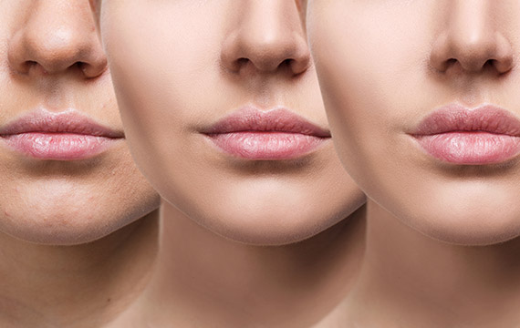 lip fillers