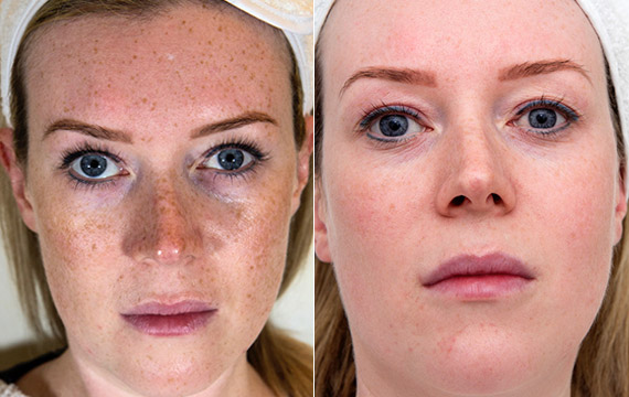 chemical peel